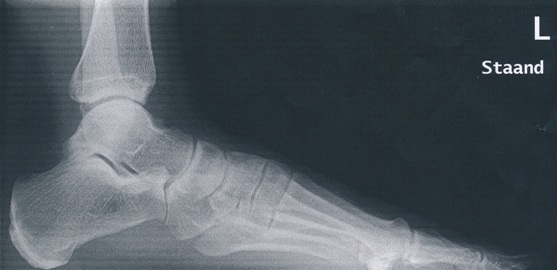 Röntgenfoto voet van opzij